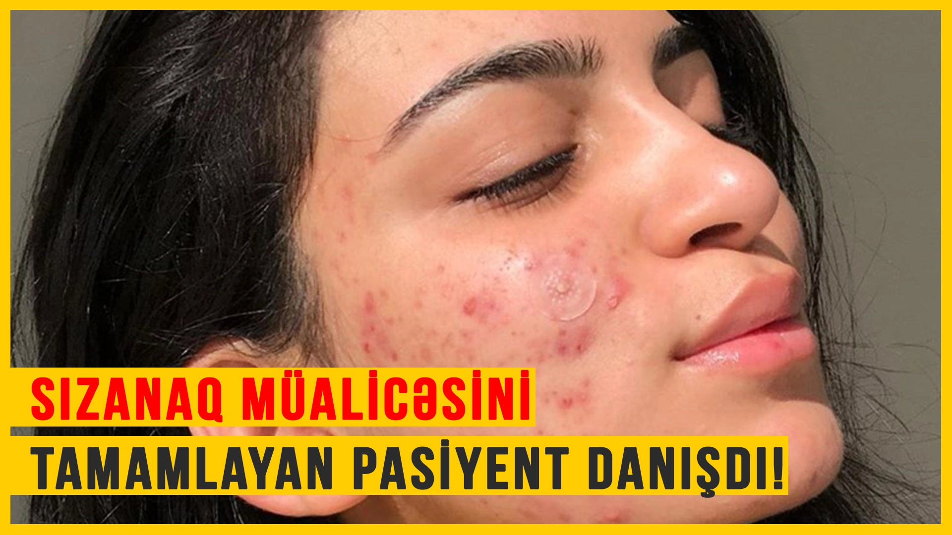 Akne (Sızanaq) Müalicəsini Tamamlayan Pasiyent Danışdı! #DERMATOLOQ