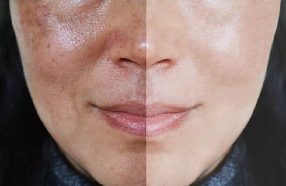 Melazma Nədir? Günəş Ləkələri - Deri Hekimi (Dermatoloq)