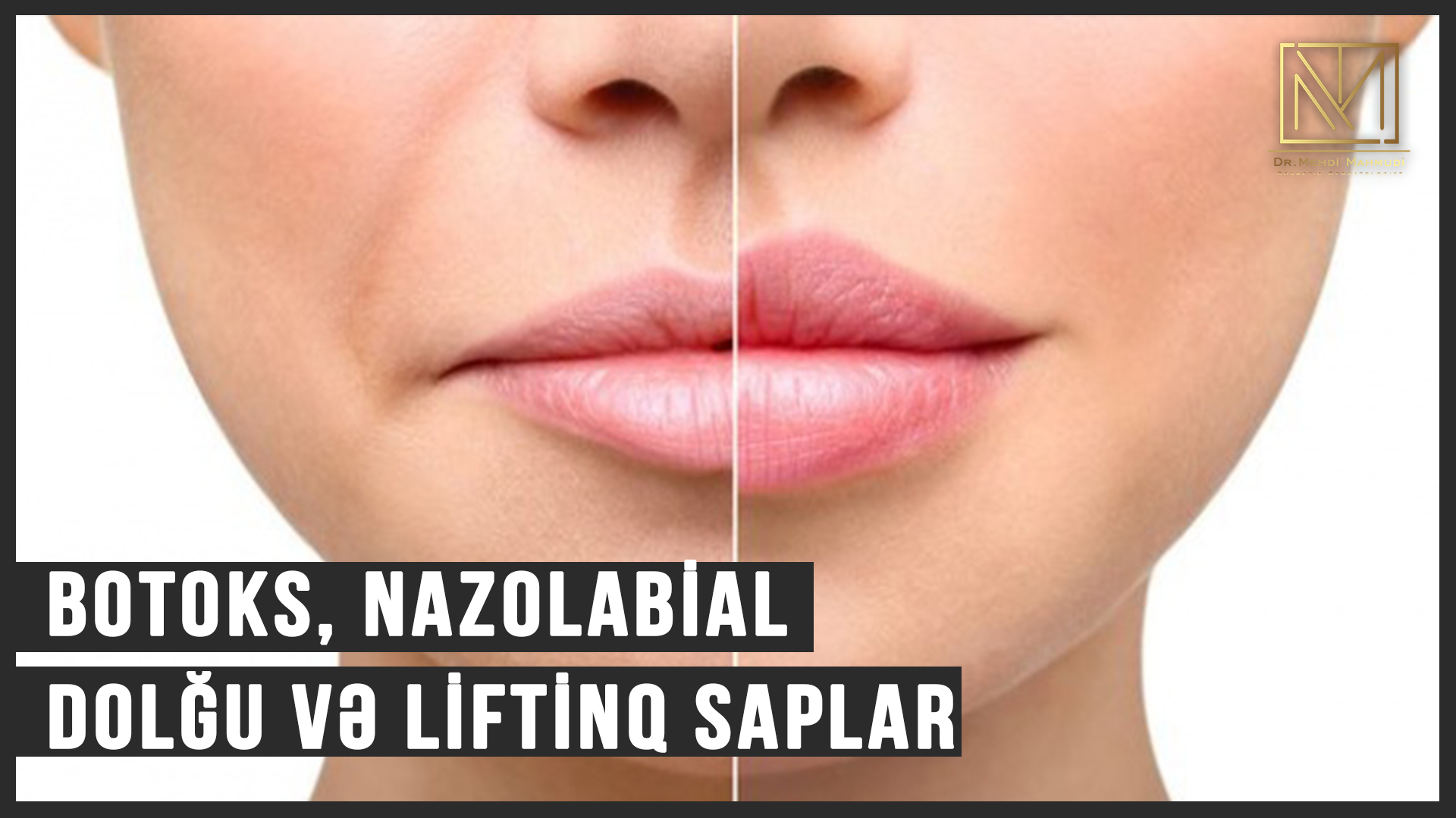Anti Aging Program: Botoks, Nazolabial Dolğu və Liftinq Saplar