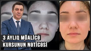 Dermatoloq / 3 aylıq müalicə kursunun nəticəsi / Dr Mehdi