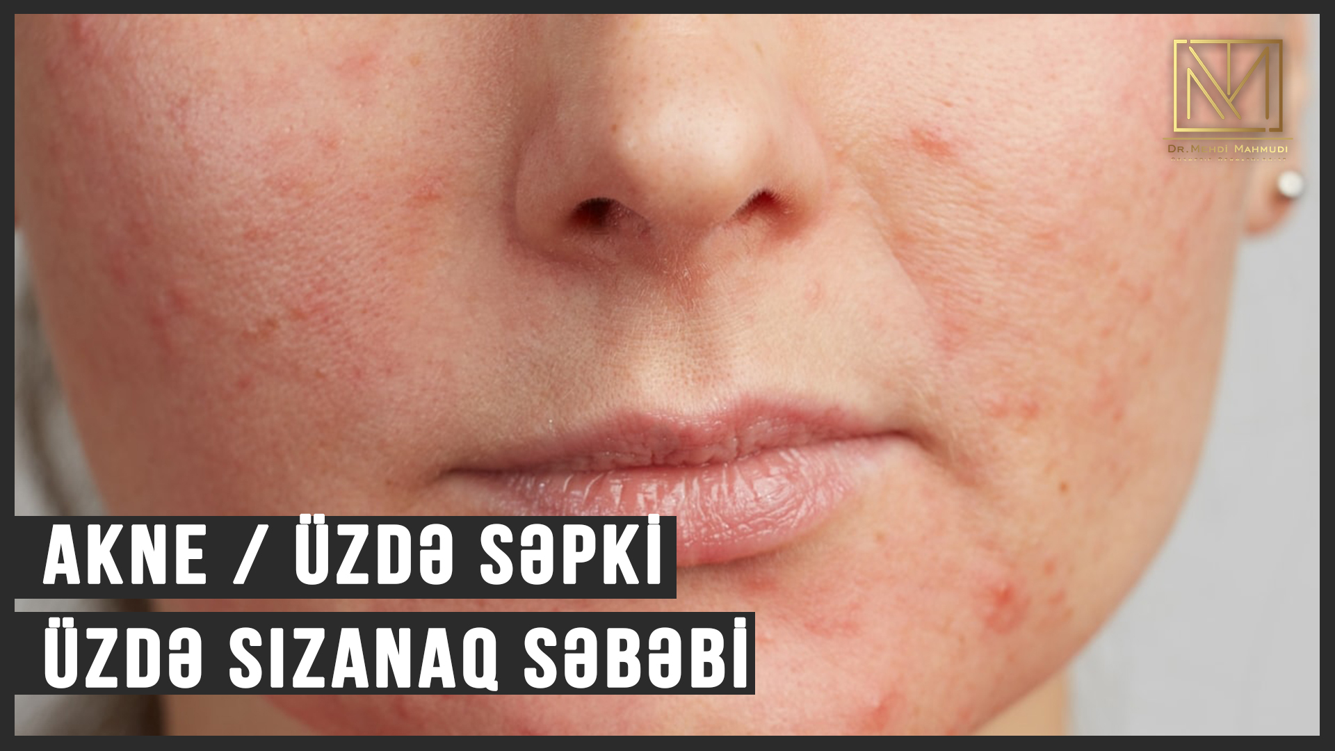 AKNE / UZDE SEPKI / ÜZDƏ SIZANAQ SƏBƏBİ VƏ MÜALİCƏSİ HAQQINDA - #DERMATOLOQ