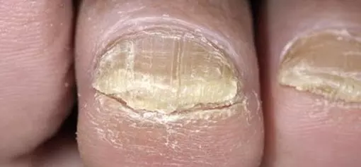 Dırnaq Xəstəlikləri Müalicə Olunurmu? Dermatoloq Həkim